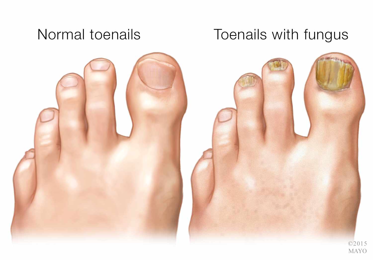 The Solution To Nasty Toenails...